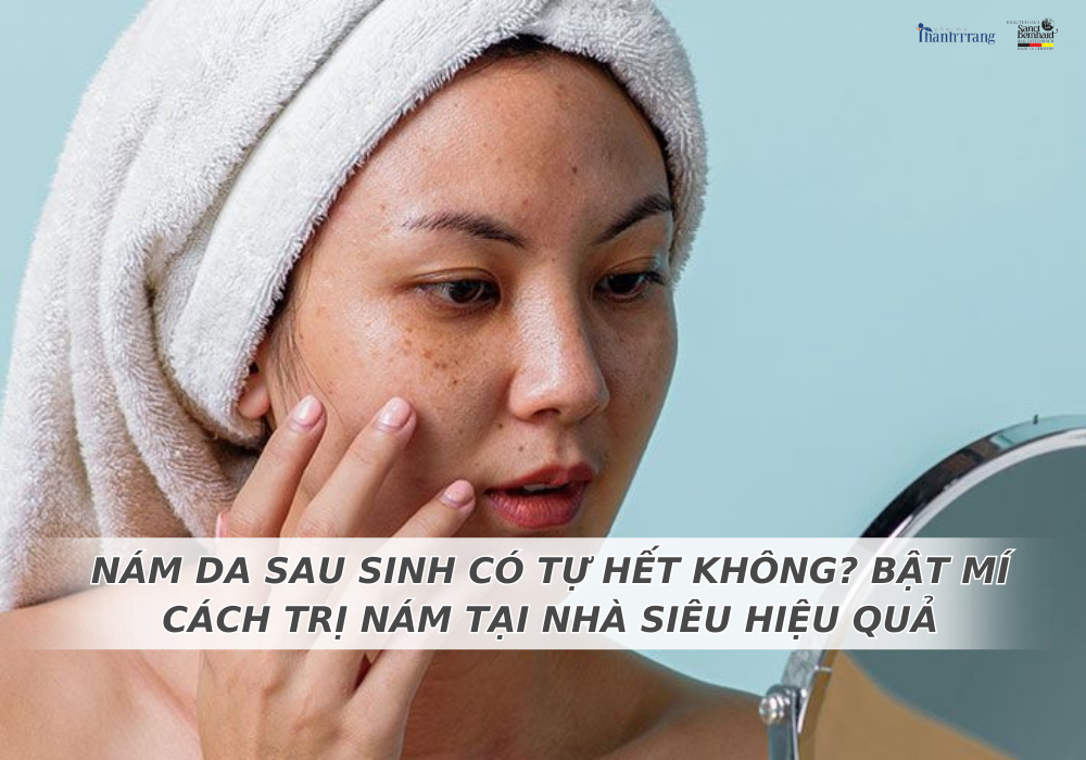 NÁM DA SAU SINH CÓ TỰ HẾT KHÔNG? BẬT MÍ CÁCH TRỊ NÁM TẠI NHÀ SIÊU HIỆU QUẢ